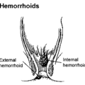 hemorrhoids free clipart