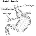 hiatal hernia free clipart