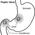 peptic ulcer free clipart